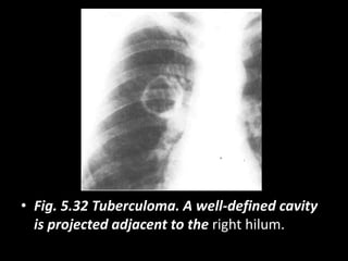 • Fig. 5.32 Tuberculoma. A well-defined cavity
is projected adjacent to the right hilum.
 