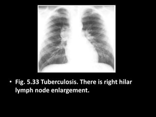 • Fig. 5.33 Tuberculosis. There is right hilar
lymph node enlargement.
 