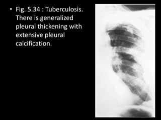 • Fig. 5.34 : Tuberculosis.
There is generalized
pleural thickening with
extensive pleural
calcification.
 