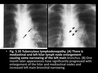 • Fig. 5.35 Tuberculous lymphadenopathy. (A) There is
mediastinal and left hilar lymph node enlargement
causing some narrowing of the left main bronchus. (B) One
month later appearances have significantly progressed with
enlargement of the hilar and mediastinal nodes and
increased left main bronchial narrowing.
 
