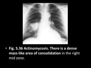 • Fig. 5.36 Actinomycosis. There is a dense
mass-like area of consolidation in the right
mid zone.
 
