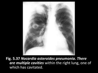 Fig. 5.37 Nocardia asteroides pneumonia. There
are multiple cavities within the right lung, one of
which has cavitated.
 