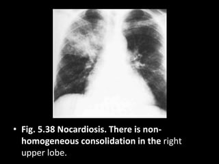• Fig. 5.38 Nocardiosis. There is non-
homogeneous consolidation in the right
upper lobe.
 