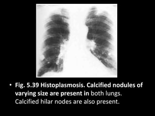 • Fig. 5.39 Histoplasmosis. Calcified nodules of
varying size are present in both lungs.
Calcified hilar nodes are also present.
 