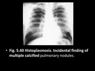 • Fig. 5.40 Histoplasmosis. Incidental finding of
multiple calcified pulmonary nodules.
 