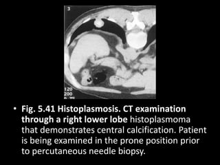 • Fig. 5.41 Histoplasmosis. CT examination
through a right lower lobe histoplasmoma
that demonstrates central calcification. Patient
is being examined in the prone position prior
to percutaneous needle biopsy.
 