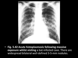 • Fig. 5.42 Acute histoplasmosis following massive
exposure whilst visiting a bat-infested cave. There are
widespread bilateral well-defined 3-5-mm nodules.
 