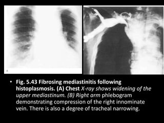 • Fig. 5.43 Fibrosing mediastinitis following
histoplasmosis. (A) Chest X-ray shows widening of the
upper mediastinum. (B) Right arm phlebogram
demonstrating compression of the right innominate
vein. There is also a degree of tracheal narrowing.
 