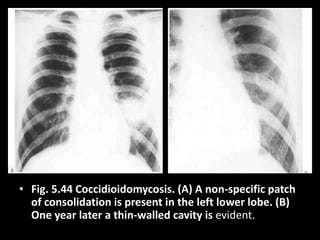 • Fig. 5.44 Coccidioidomycosis. (A) A non-specific patch
of consolidation is present in the left lower lobe. (B)
One year later a thin-walled cavity is evident.
 