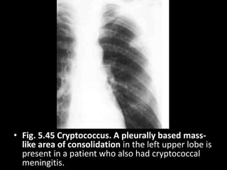 • Fig. 5.45 Cryptococcus. A pleurally based mass-
like area of consolidation in the left upper lobe is
present in a patient who also had cryptococcal
meningitis.
 