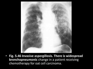 • Fig. 5.46 Invasive aspergillosis. There is widespread
bronchopneumonic change in a patient receiving
chemotherapy for oat cell carcinoma.
 