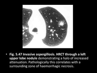 • Fig. 5.47 Invasive aspergillosis. HRCT through a left
upper lobe nodule demonstrating a halo of increased
attenuation. Pathologically this correlates with a
surrounding zone of haemorrhagic necrosis.
 