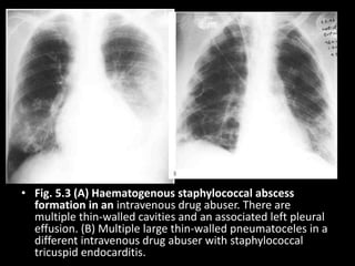 • Fig. 5.3 (A) Haematogenous staphylococcal abscess
formation in an intravenous drug abuser. There are
multiple thin-walled cavities and an associated left pleural
effusion. (B) Multiple large thin-walled pneumatoceles in a
different intravenous drug abuser with staphylococcal
tricuspid endocarditis.
 