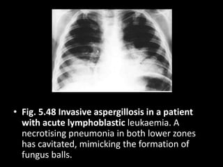 • Fig. 5.48 Invasive aspergillosis in a patient
with acute lymphoblastic leukaemia. A
necrotising pneumonia in both lower zones
has cavitated, mimicking the formation of
fungus balls.
 