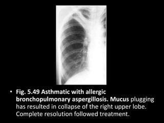 • Fig. 5.49 Asthmatic with allergic
bronchopulmonary aspergillosis. Mucus plugging
has resulted in collapse of the right upper lobe.
Complete resolution followed treatment.
 