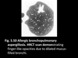 Fig. 5.50 Allergic bronchopulmonary
aspergillosis. HRCT scan demonstrating
finger-like opacities due to dilated mucus-
filled bronchi.
 