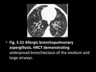• Fig. 5.51 Allergic bronchopulmonary
aspergillosis. HRCT demonstrating
widespread bronchiectasis of the medium and
large airways.
 