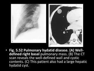• Fig. 5.52 Pulmonary hydatid disease. (A) Well-
defined right basal pulmonary mass. (B) The CT
scan reveals the well-defined wall and cystic
contents. (C) This patient also had a large hepatic
hydatid cyst.
 