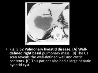 • Fig. 5.52 Pulmonary hydatid disease. (A) Well-
defined right basal pulmonary mass. (B) The CT
scan reveals the well-defined wall and cystic
contents. (C) This patient also had a large hepatic
hydatid cyst.
 