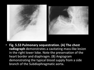 • Fig. 5.53 Pulmonary sequestration. (A) The chest
radiograph demonstrates a cavitating mass-like lesion
in the right lower lobe. Note the preservation of the
heart border and diaphragm. (B) Angiogram
demonstrating the typical blood supply from a side
branch of the Subdiaphragmatic aorta.
 