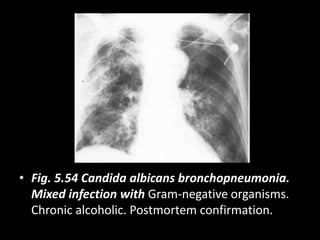 • Fig. 5.54 Candida albicans bronchopneumonia.
Mixed infection with Gram-negative organisms.
Chronic alcoholic. Postmortem confirmation.
 