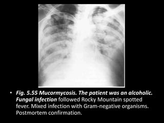 • Fig. 5.55 Mucormycosis. The patient was an alcoholic.
Fungal infection followed Rocky Mountain spotted
fever. Mixed infection with Gram-negative organisms.
Postmortem confirmation.
 