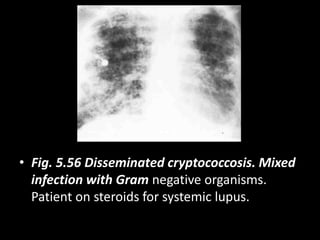 • Fig. 5.56 Disseminated cryptococcosis. Mixed
infection with Gram negative organisms.
Patient on steroids for systemic lupus.
 