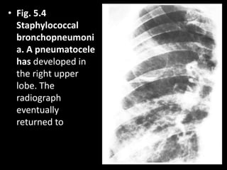 • Fig. 5.4
Staphylococcal
bronchopneumoni
a. A pneumatocele
has developed in
the right upper
lobe. The
radiograph
eventually
returned to
 