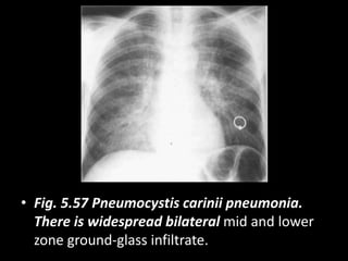 • Fig. 5.57 Pneumocystis carinii pneumonia.
There is widespread bilateral mid and lower
zone ground-glass infiltrate.
 