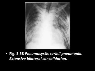 • Fig. 5.58 Pneumocystis carinii pneumonia.
Extensive bilateral consolidation.
 