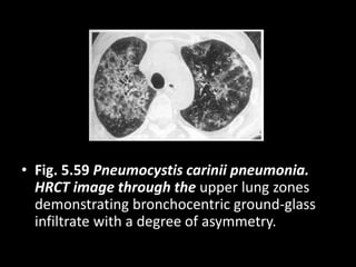 • Fig. 5.59 Pneumocystis carinii pneumonia.
HRCT image through the upper lung zones
demonstrating bronchocentric ground-glass
infiltrate with a degree of asymmetry.
 
