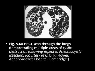 • Fig. 5.60 HRCT scan through the lungs
demonstrating multiple areas of cystic
destruction following repeated Pneumocystis
infection. (Courtesy of C. D. R. Flower,
Addenbrooke's Hospital, Cambridge.)
 