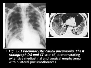 • Fig. 5.61 Pneumocystis carinii pneumonia. Chest
radiograph (A) and CT scan (B) demonstrating
extensive mediastinal and surgical emphysema
with bilateral pneumothoraces.
 