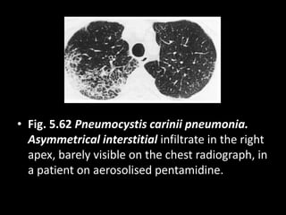 • Fig. 5.62 Pneumocystis carinii pneumonia.
Asymmetrical interstitial infiltrate in the right
apex, barely visible on the chest radiograph, in
a patient on aerosolised pentamidine.
 