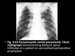 • Fig. 5.63 Pneumocystis carinii pneumonia. Chest
radiograph demonstrating bilateral apical
infiltrates in a patient on aerosolised pentamidine
prophylaxis.
 