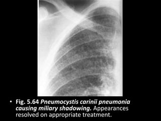 • Fig. 5.64 Pneumocystis carinii pneumonia
causing miliary shadowing. Appearances
resolved on appropriate treatment.
 