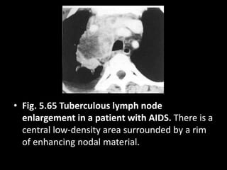• Fig. 5.65 Tuberculous lymph node
enlargement in a patient with AIDS. There is a
central low-density area surrounded by a rim
of enhancing nodal material.
 