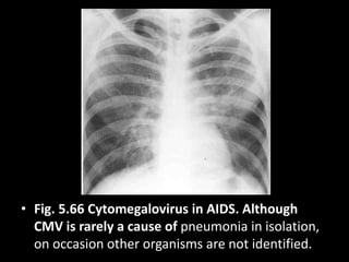 • Fig. 5.66 Cytomegalovirus in AIDS. Although
CMV is rarely a cause of pneumonia in isolation,
on occasion other organisms are not identified.
 
