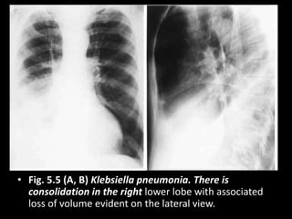 • Fig. 5.5 (A, B) Klebsiella pneumonia. There is
consolidation in the right lower lobe with associated
loss of volume evident on the lateral view.
 