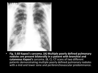 • Fig. 5.68 Kaposi's sarcoma. (A) Multiple poorly defined pulmonary
nodules are present bilaterally in a patient with bronchial and
cutaneous Kaposi's sarcoma. (B, C). CT scans of two different
patients demonstrating multiple poorly defined pulmonary nodules
with a mid and lower zone and peribronchovascular predominance.
 