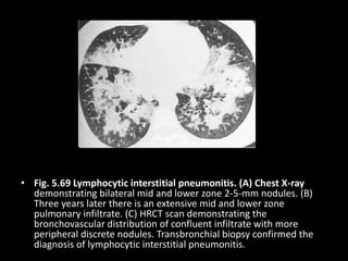 • Fig. 5.69 Lymphocytic interstitial pneumonitis. (A) Chest X-ray
demonstrating bilateral mid and lower zone 2-5-mm nodules. (B)
Three years later there is an extensive mid and lower zone
pulmonary infiltrate. (C) HRCT scan demonstrating the
bronchovascular distribution of confluent infiltrate with more
peripheral discrete nodules. Transbronchial biopsy confirmed the
diagnosis of lymphocytic interstitial pneumonitis.
 