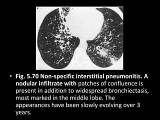 • Fig. 5.70 Non-specific interstitial pneumonitis. A
nodular infiltrate with patches of confluence is
present in addition to widespread bronchiectasis,
most marked in the middle lobe. The
appearances have been slowly evolving over 3
years.
 
