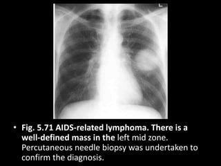 • Fig. 5.71 AIDS-related lymphoma. There is a
well-defined mass in the left mid zone.
Percutaneous needle biopsy was undertaken to
confirm the diagnosis.
 