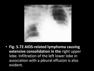 • Fig. 5.72 AIDS-related lymphoma causing
extensive consolidation in the right upper
lobe. Infiltration of the left lower lobe in
association with a pleural effusion is also
evident.
 