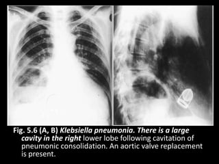 Fig. 5.6 (A, B) Klebsiella pneumonia. There is a large
cavity in the right lower lobe following cavitation of
pneumonic consolidation. An aortic valve replacement
is present.
 