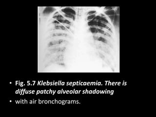 • Fig. 5.7 Klebsiella septicaemia. There is
diffuse patchy alveolar shadowing
• with air bronchograms.
 