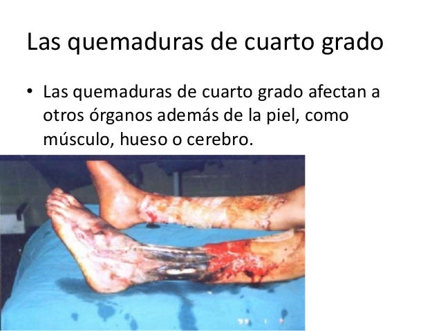 Patologia Quirurgica Quemaduras Patologia Quirurgica Quemaduras