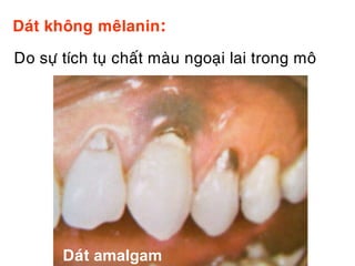 Daùt khoâng meâlanin:

Do söï tích tuï chaát maøu ngoaïi lai trong moâ




       Daùt amalgam
 