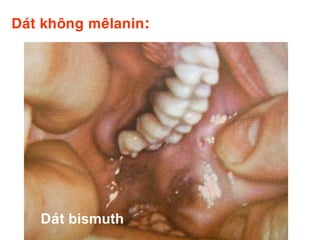 Daùt khoâng meâlanin:




    Daùt bismuth
 