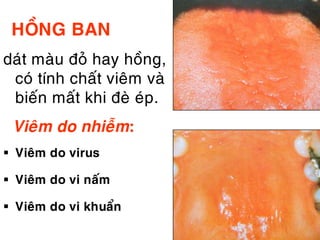 HOÀNG BAN
daùt maøu ñoû hay hoàng,
 coù tính chaát vieâm vaø
 bieán maát khi ñeø eùp.
 Vieâm do nhieãm:
 Vieâm do virus

 Vieâm do vi naám

 Vieâm do vi khuaån
 